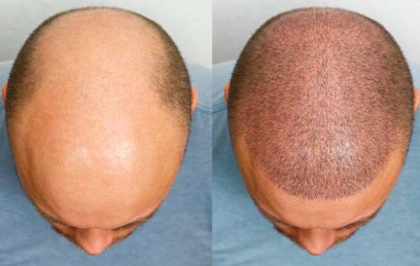 Hair Transplant Journey from Hair Loss to Hair Regrowth