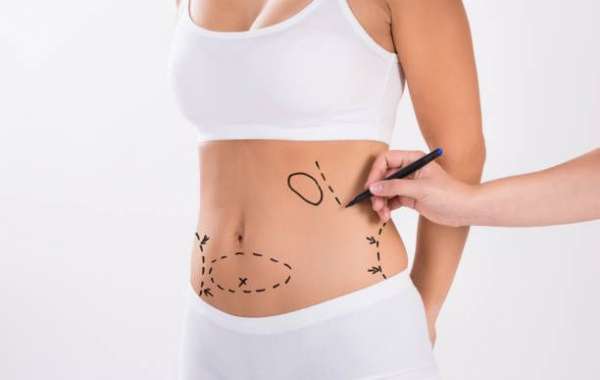 Liposuction for Improving Body Proportion Naturally