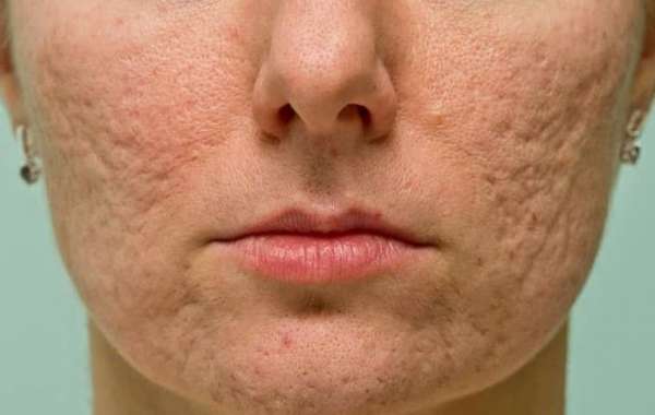 Brad Pitt’s Acne Scar Treatment Reveals Radiance in Days