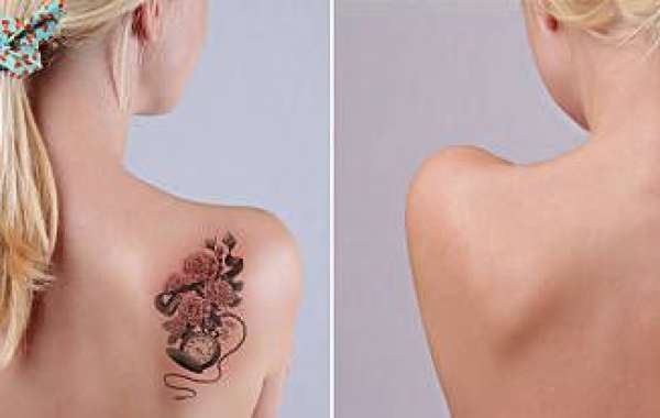 Laser Tattoo Removal for Safely Clearing Unwanted Ink