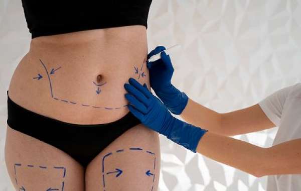 Tummy Tuck Inspiration for a Fresh Start in Body Confidence