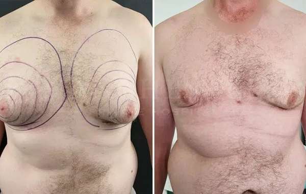 Gynecomastia Surgery Cost for Complex Cases