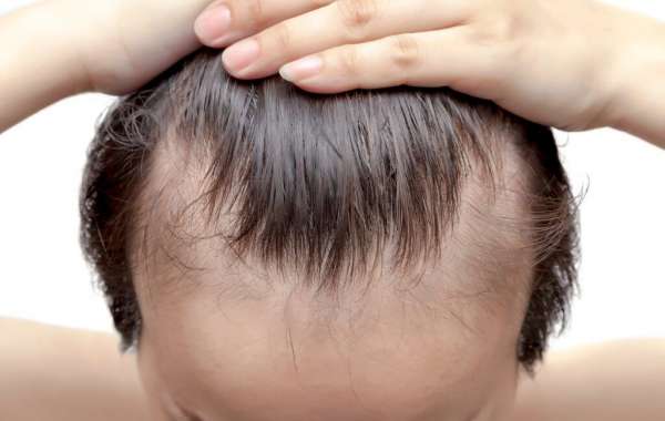 Hair Loss Treatment With Regular Checkups
