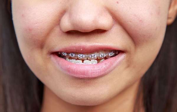 Dental Braces for Underbite: How They Help
