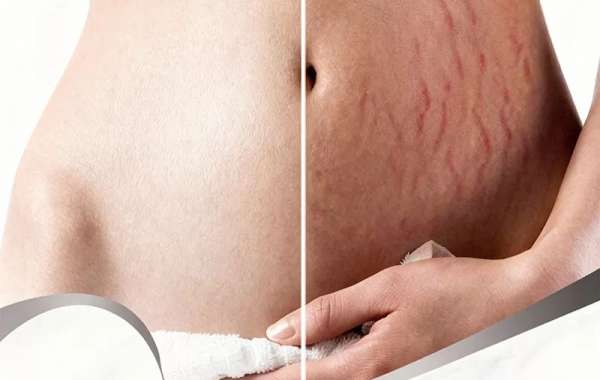 Laser Stretch Marks Treatment for Old vs New Stretch Marks