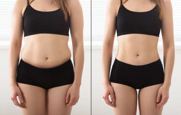 Laser Liposuction Results: Real Patient Expectations