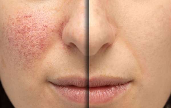 5 Things That Make Enfield Royal Clinic Stand Out for Syringoma Removal