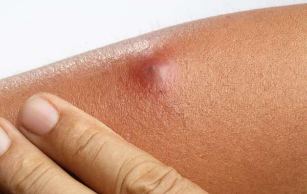 Incision and Drainage of Abscesses for Fast Relief and Healing Flow