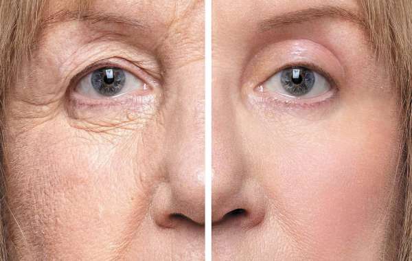 Eye Bag Removal is it the boost for tired eye revival?