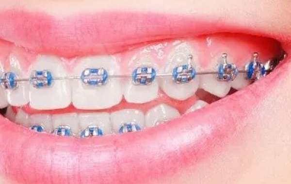 Bright Smile Dental Braces in Dubai – Radiant Smile Transformation Journey
