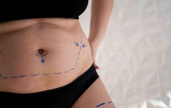 Does Vaser 4D Liposuction reshape your core aesthetics?