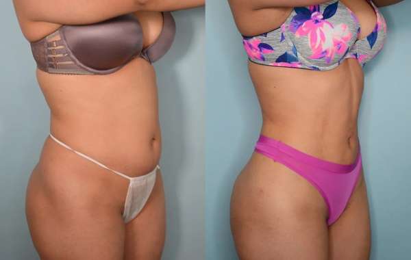 How Effective Is Liposuction for Stubborn Fat Reduction?