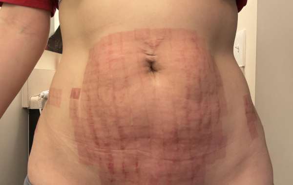 Choosing the Best Stretch Marks Treatment Clinic in Dubai