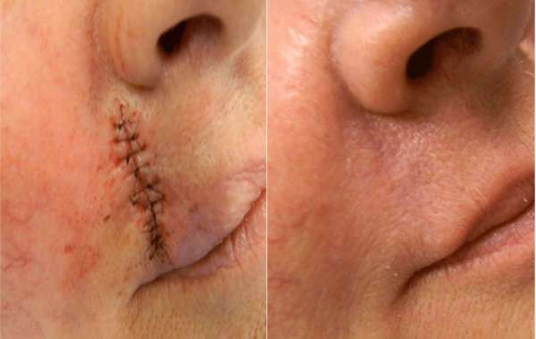 Surgical Scar Revision Clinics Delivering Natural-Looking Resultt