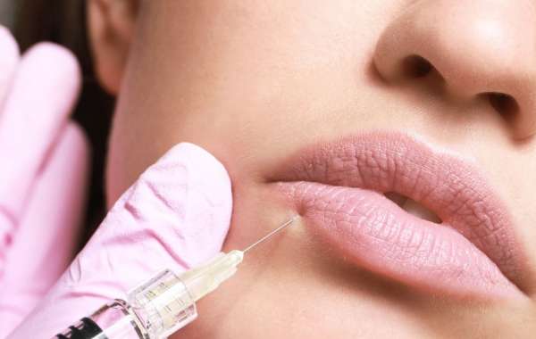 Everything You Need to Know About Botox Lip Flip