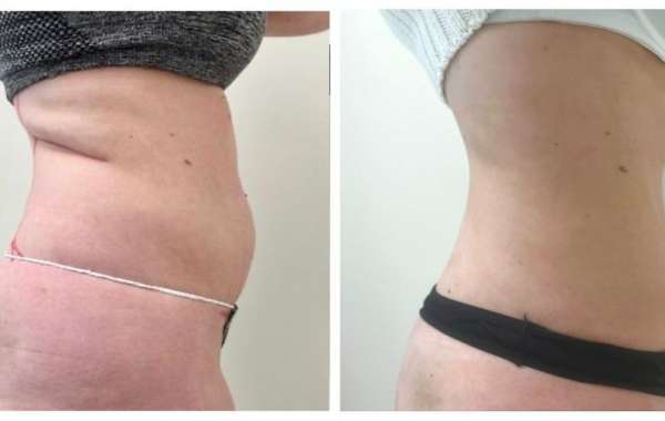 Fat Removal Surgery With Personalized Treatment Plans